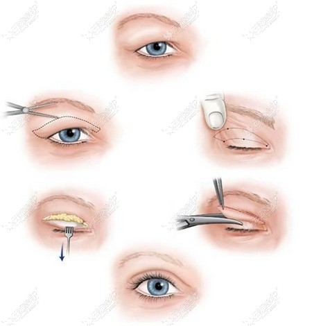 全切双眼皮手术过程
