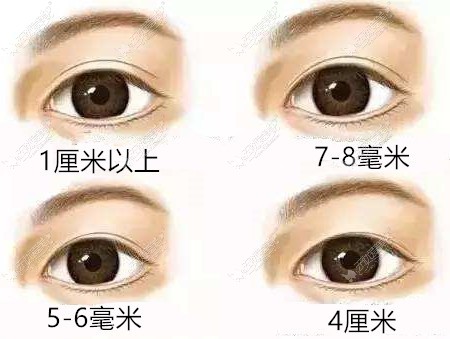 不同宽度的双眼皮类型