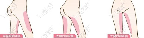 重100斤,大腿52厘米的姑娘做宝丽太吸脂能瘦多少？