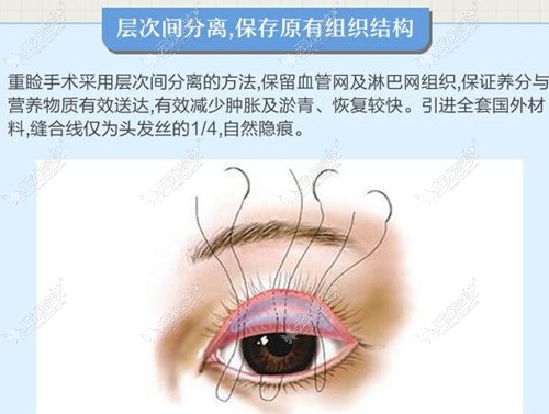 鹿世江双眼皮手术方法