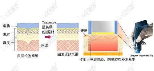 热玛吉治疗原理