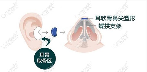 假体+耳软骨垫鼻尖的优势