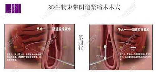 3D生物束带缩阴手术方式