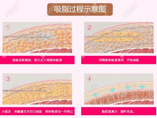 席小红医生的水动力吸脂优势