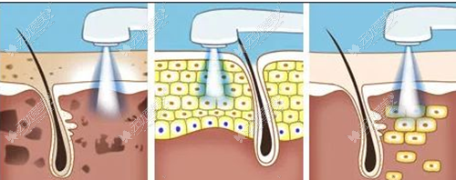 光子嫩肤治疗原理
