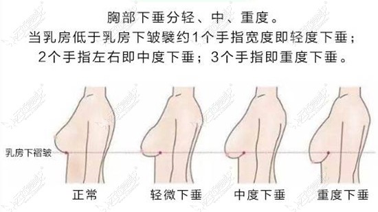 乳房下垂矫正疤痕明显吗？做过大胸下垂矫正的来说说效果