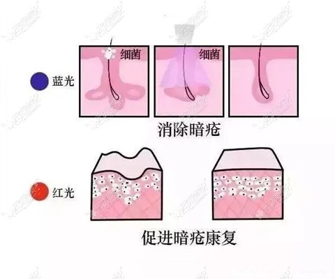 红蓝光祛痘原理