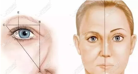 提眉手术选择眉下切口眼皮提紧术多久可以恢复自然？