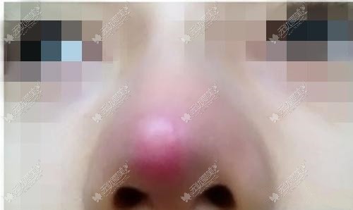 做完肋骨鼻1个月后鼻头圆大还发红可以只修复鼻头吗?