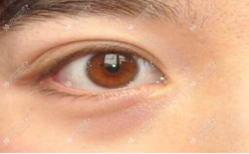 纳米脂肪填充黑眼圈是否有用要看你是什么类型的黑眼圈