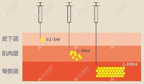 胡上雄做面部脂肪填充的优势