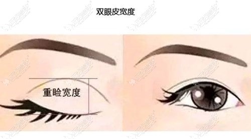 薛斌医生双眼皮手术优势