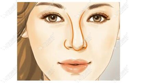 鼻综合手术后发现耳软骨垫的鼻尖移位歪向一边怎么修复？