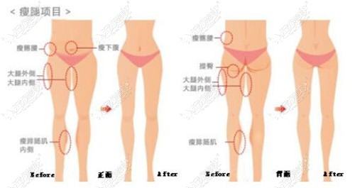 大腿吸脂第5天会肿的比较厉害,大概6个月后能变瘦定型