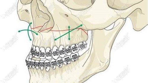 几年前正畸拔牙四颗现在还能再做正颌手术吗？