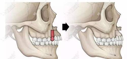 正颌手术一般都需要拔牙