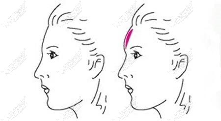 自体脂肪丰额头后脂肪存活率高的话,效果不止3年