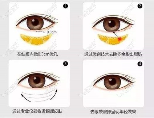 北京紫洁不开刀去眼袋其实用的是射频消融的微创方式,可靠!