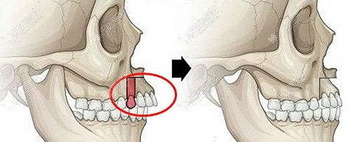 牙槽骨前突的矫正方法
