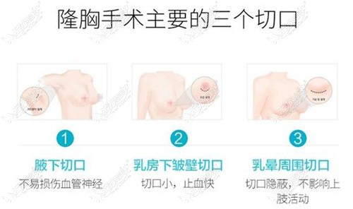 假体隆胸的三种切口