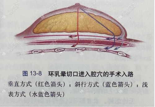 乳晕切口的弊端