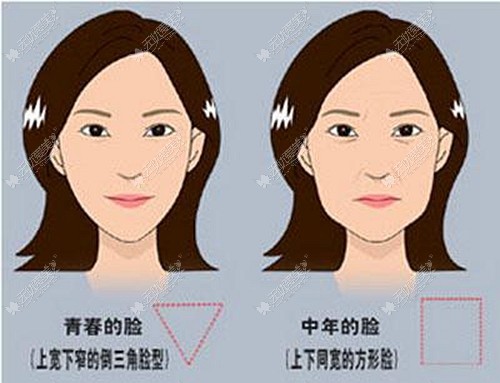 50岁面部松弛下垂适合做小切口拉皮