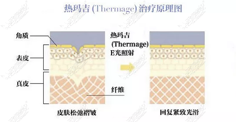 热玛吉治疗原理