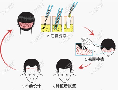 发际线种植原理