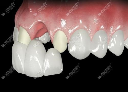 氧化锆全瓷牙会透出原本牙齿的颜色吗?做自然色还是白色好