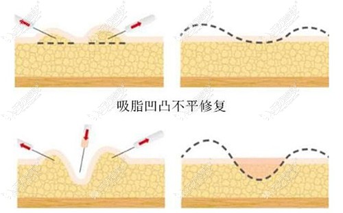 大腿环吸凹陷修复手术原理