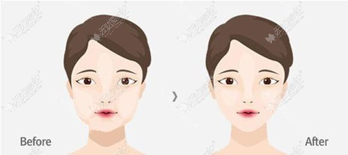 求问取颊脂垫和面部吸脂区别,做哪个瘦脸不会引起面部下垂