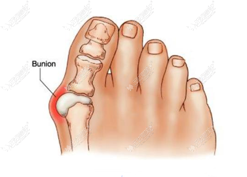 一下拇外翻的原因,拇外翻俗称大脚骨,多数是由于大拇拇趾本节关节凸
