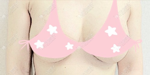 乳房悬吊双环术恢复图片对比
