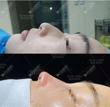 用驼峰鼻磨骨手术过程及真实图片证实:不会凹凸不平和增生