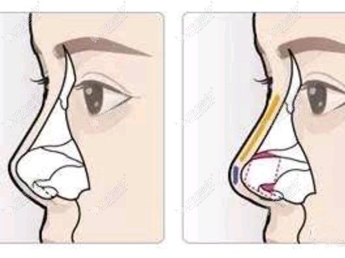 鼻头挛缩修复的方法