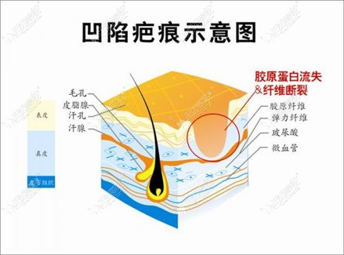 凹陷疤痕形成原因