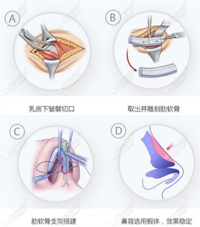 杭州张龙医生做鼻子过程