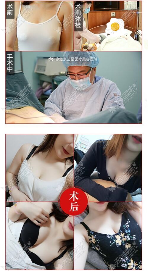 赵志伟医生曼托假体隆胸案例