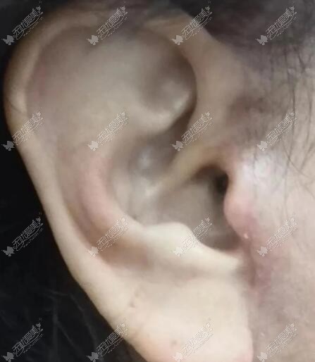 耳小切前口拉皮手术三个月疤痕图片