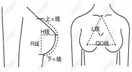 隆胸假体选择标准