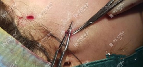 大拉皮的手术缝线切口