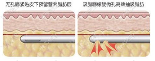 贵阳华美吸脂针的优势