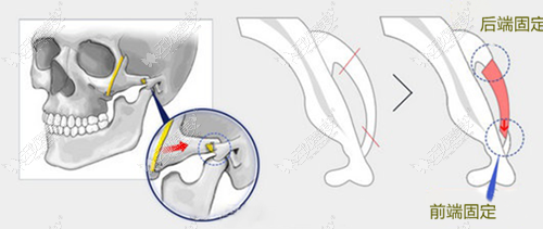 颧骨内推手术不固定