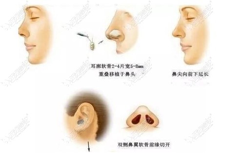 耳软骨隆鼻手术过程
