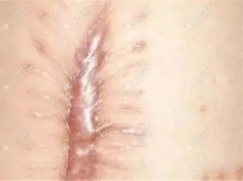 手术缝线疤痕
