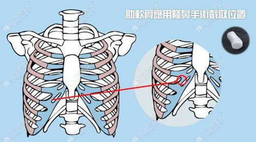 取的肋软骨部位