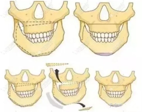 牙齿中线不齐导致的脸歪可以矫正吗,提供偏颌矫正的方法