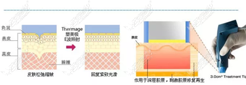 热玛吉原理