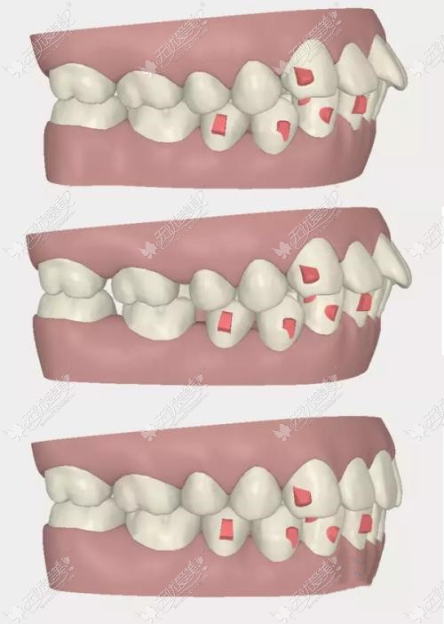 正畸矫正龅牙的过程