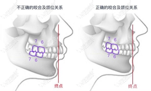 明白造成下颌后缩的原因就知道改善是选正颌还是颏成型了